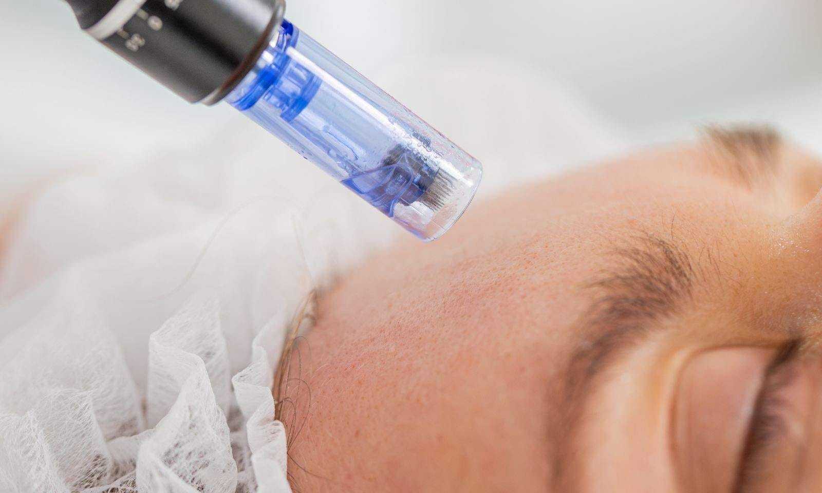 A close-up of a microneedling procedure on a person's face.