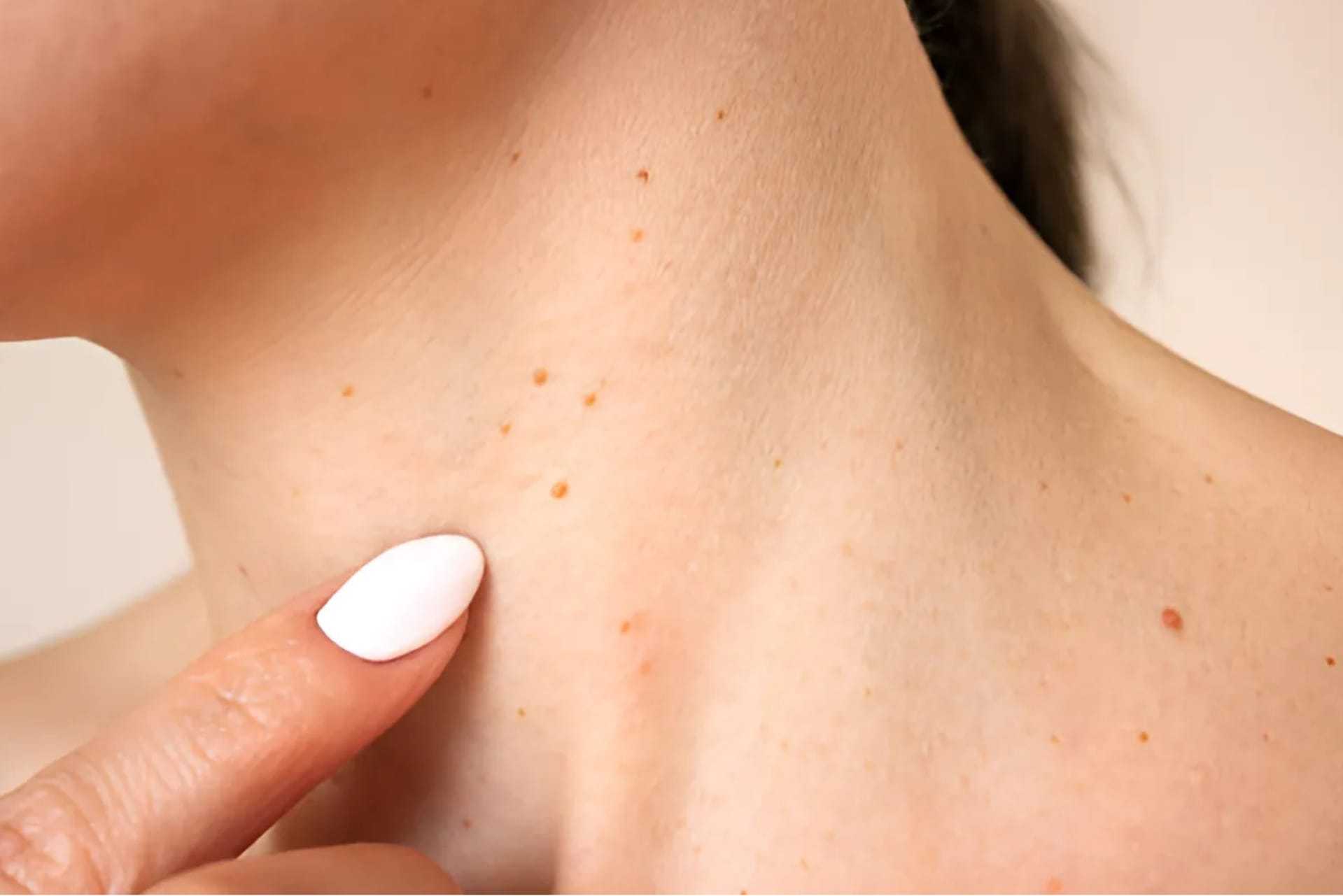 Small moles on a person's neck with a hand pointing, highlighting skin features.